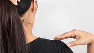 средства от перхоти